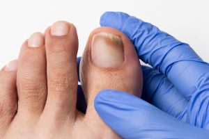 Fungal Nail Infection treatment